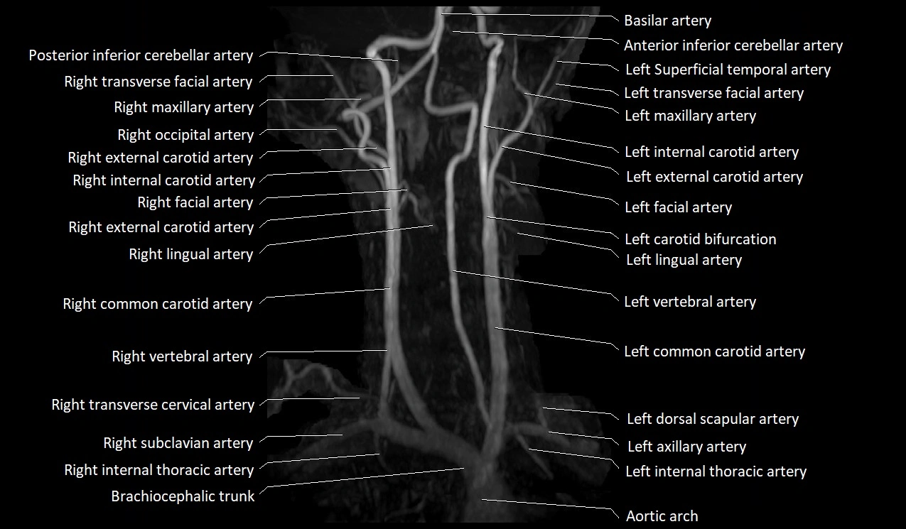 MRA neck carotid arteries labeled anatomy image MIP 3D image 8.webp